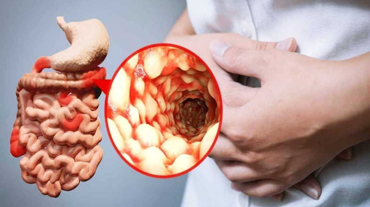 Колиты - одно из самых распространенных заболеваний человека