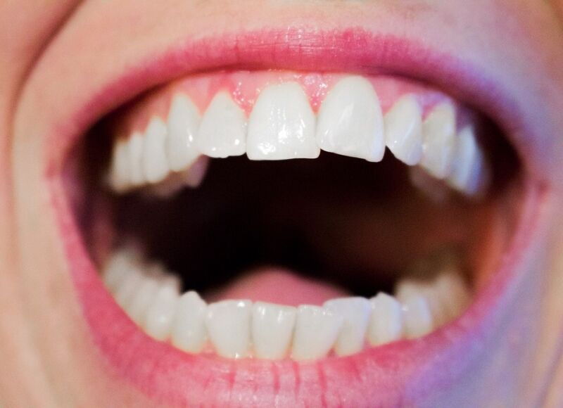 Делаем «голливудскую улыбку» при помощи металлических брекетов: советы врача-ортодонта