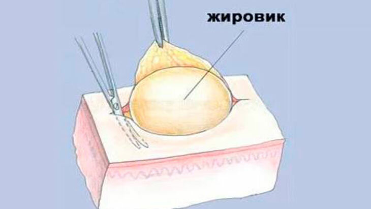 Причины возникновения жировиков на лице однако, может, жировики, липомы, также, можно, возникновения, кожей, жировиков, правило, жировика, милиумы, мелкие, жировой, часто, средств, смотря, более, содержимого, причины