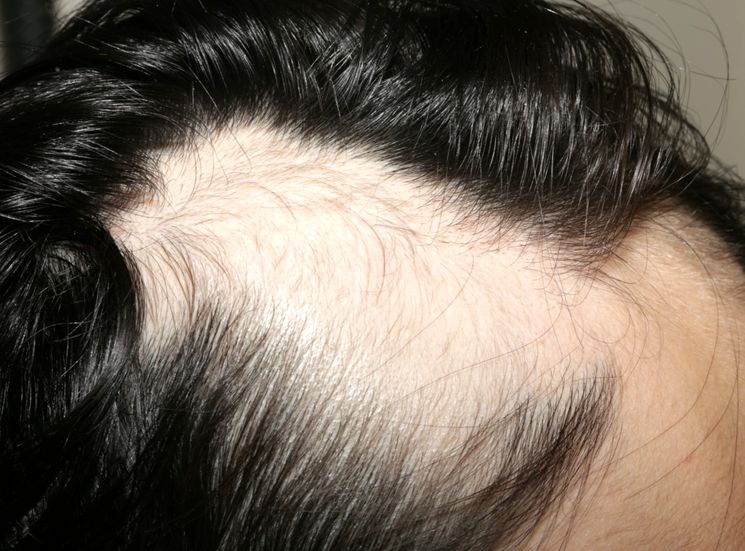 Алопеция — виды, причины и методы лечения облысения волос, алопеция, лечения, головы, после, выпадения, волосы, человека, могут, часто, выпадение, может, алопеции, заболевания, являются, облысения, роста, выпадают, средств, препараты