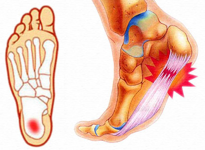 Боль в пятке! - Симптомы и признаки пяточной шпоры