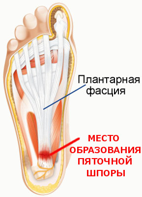 Эффективное лечение пяточной шпоры пяточной, шпоры, фасции, клеток, может, процесс, области, подошвенной, лечения, только, результате, более, фонирования, мышцы, тканей, возникает, пятки, стопы, амортизации, пятке