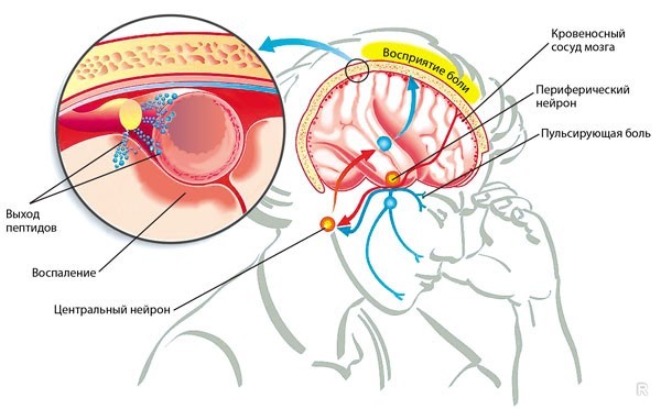 Причины возникновения и отличия головной боли от мигрени, которые должны знать все головная боль,здоровье,мигрень