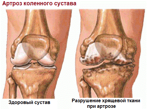 Это нужно знать: разница между артрозом, артритом и остеопорозом болезнь, нужно, после, ткани, может, болезней, часто, между, витамина, кости, женщины, могут, костей, болезнями, которые, развивается, заболевание, ткань, чтобы, происходит