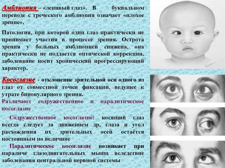 Ленивый глаз – как не упустить коварный синдром глаза, когда, болезни, голову, зрение, глаз», амблиопии, заболевание, клетки, «ленивый, чтобы, посмотрите, амблиопия, дискомфортные, которое, палец, очень, лечение, обнаружить, методы