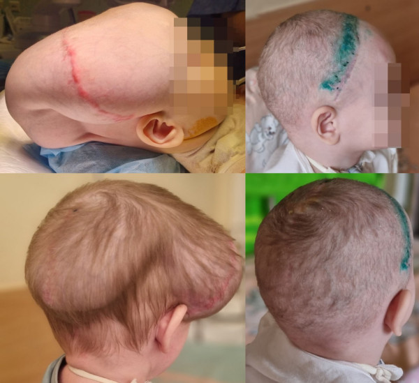 Российские нейрохирурги смогли вылечить двухлетнюю девочку с жуткой деформацией головы