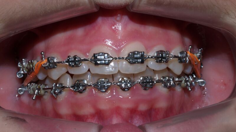 Делаем «голливудскую улыбку» при помощи металлических брекетов: советы врача-ортодонта