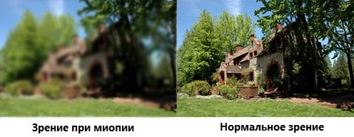 Нормальное зрение и зрение при миопии