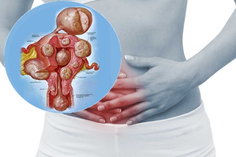 Фибромы, миомы и щитовидка: 10 рецептов лечения от знахаря