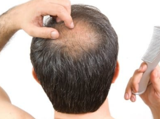 Лучшие средства против облысения у мужчин: рейтинг средств против облысения