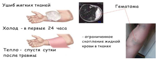 Отчего появляются синяки на теле: причины, симптомы, оказание первой помощи травма, обычно, тканей, травмы, время, мышцы, удара, глубину, напряжение, случае, повреждения, регенерацию, ушиба, более, конечности, может, которая, Однако, следует, поврежденных