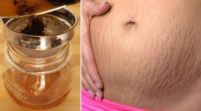 stretch-marks-FI-759x420-696x385
