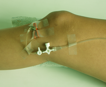 Внутрикостная инфузия армия