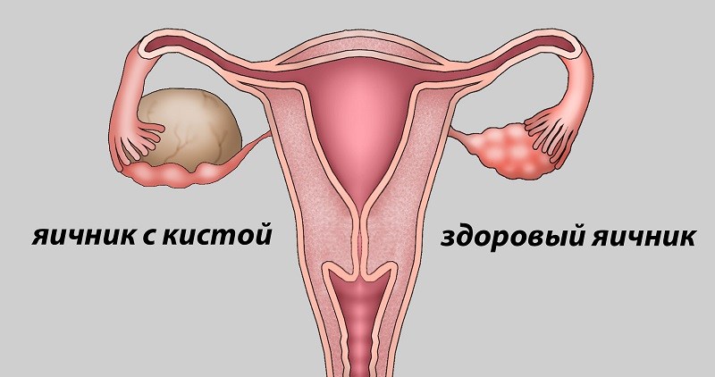 диагнозы в гинекологии