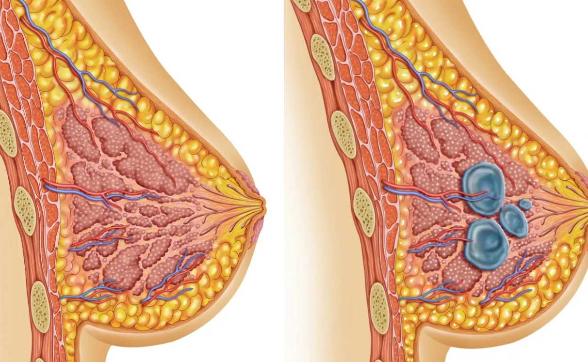 Фибромы, миомы и щитовидка: 10 рецептов лечения от знахаря