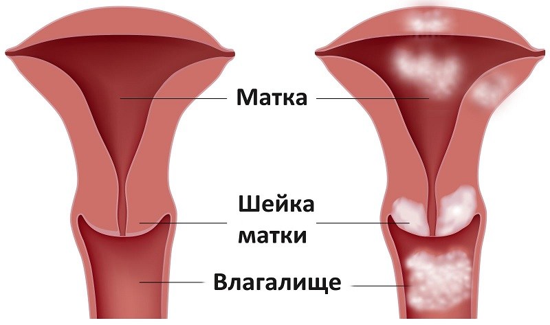 диагнозы в гинекологии