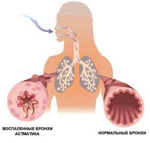 Рецепты народной медицины при бронхиальной астме
