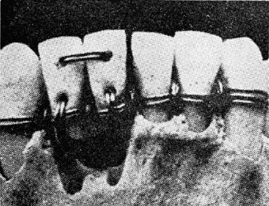 Воск, ртуть и пептиды. Краткая история стоматологических материалов — от древности до наших дней зубов, материалов, стоматологии, материалы, зубной, материала, в качестве, более, биоактивные, кальция, которые, поверхности, на основе, амальгамы, описал, цемент, зубных, технику, цинка, является