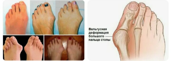  Наши стопы (в том числе пальцы ног и пальцы) играют огромную роль в сохранении здоровья всего тела.-7