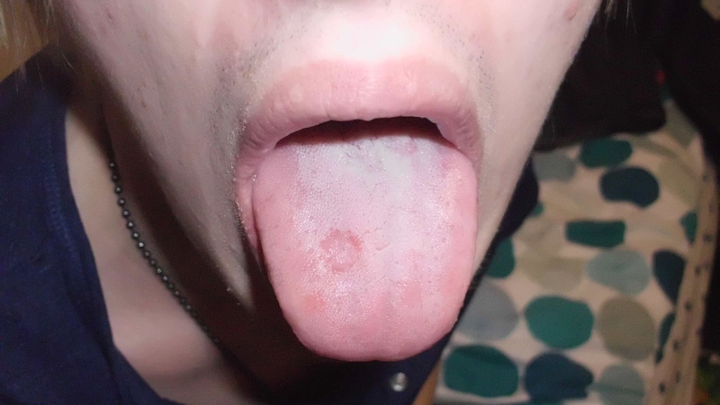 Подозреваемый отрезал себе язык из-за боязни проболтаться сыщикам