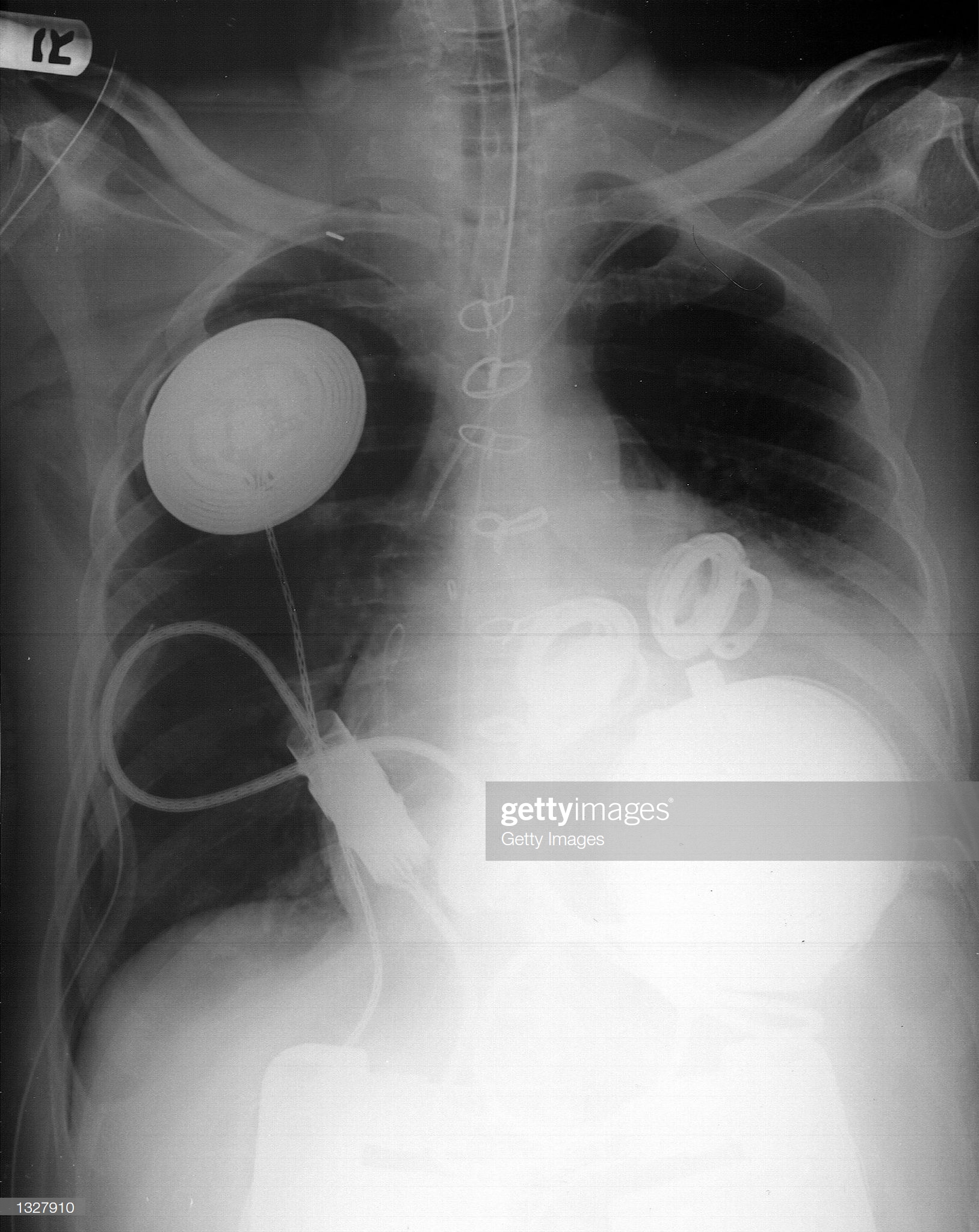 AbioCor Replacement Heart : News Photo