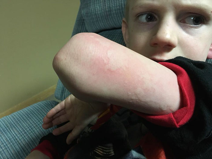son-flu-symptom-hives-influenza-brodi-willard-1