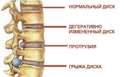 грыжа позвоночника