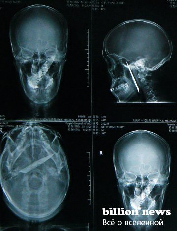 Самые интересные факты: человек прожил 4 года с ножом в черепе