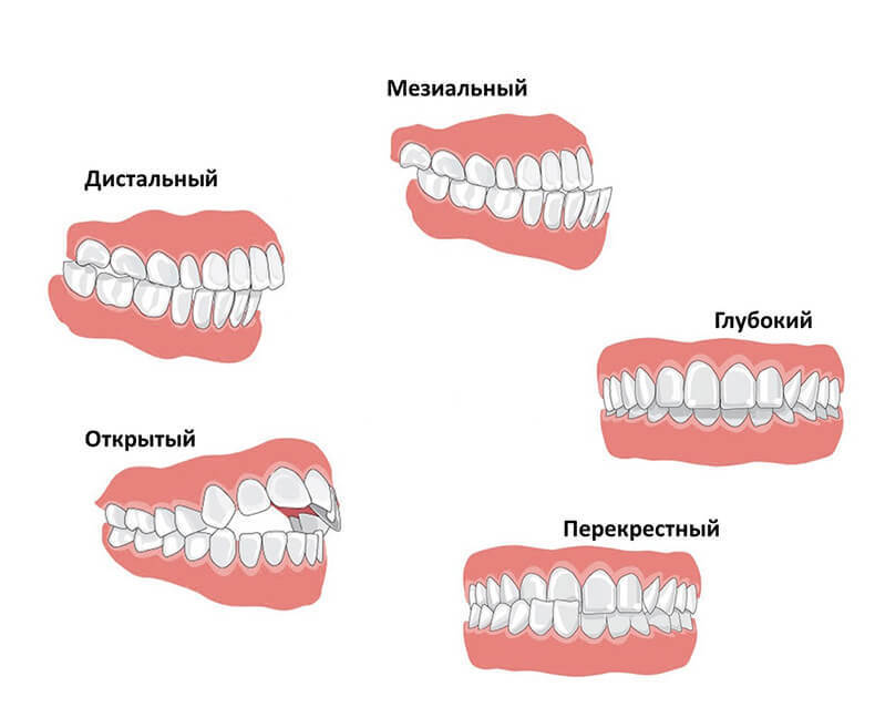 Исправление прикуса методом остеопатии