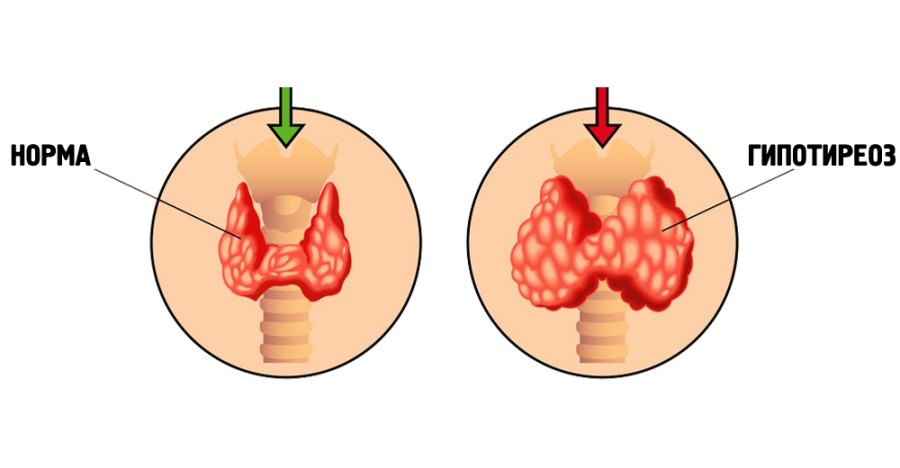 Гипотиреоз презентация казакша
