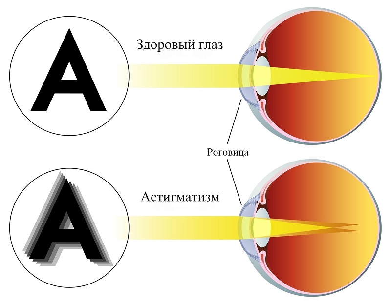 коррекция астигматизма