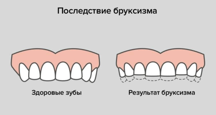 Почему люди скрипят зубами во сне и что с этим делать? болезни человека,здоровье и медицина,здоровье человека,технологии для лечения