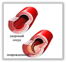 Заболевание атеросклероз 