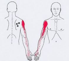 Карта точек боли в теле и точек напряжения мышц (триггеры)