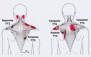 Карта точек боли в теле и точек напряжения мышц (триггеры)