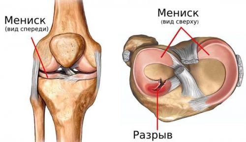 Мениск колена поврежденный. Этиология 01