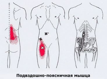 Карта точек боли в теле и точек напряжения мышц (триггеры)