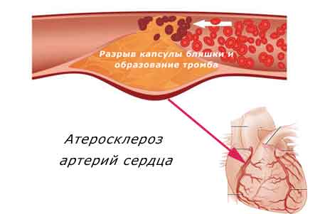 атеросклероз сосудов сердца