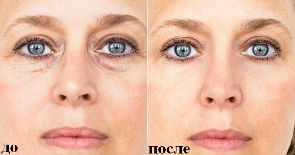 7 советов, которые избавят тебя от мешков под глазами. Взгляни на мир по-новому. 7 советов, которые избавят тебя от мешков под глазами. Взгляни на мир по-новому.
