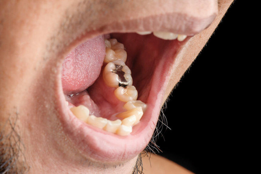 На пятом зубе дистально видим кариес, на шестом прекрасную амальгамовую пломбу
