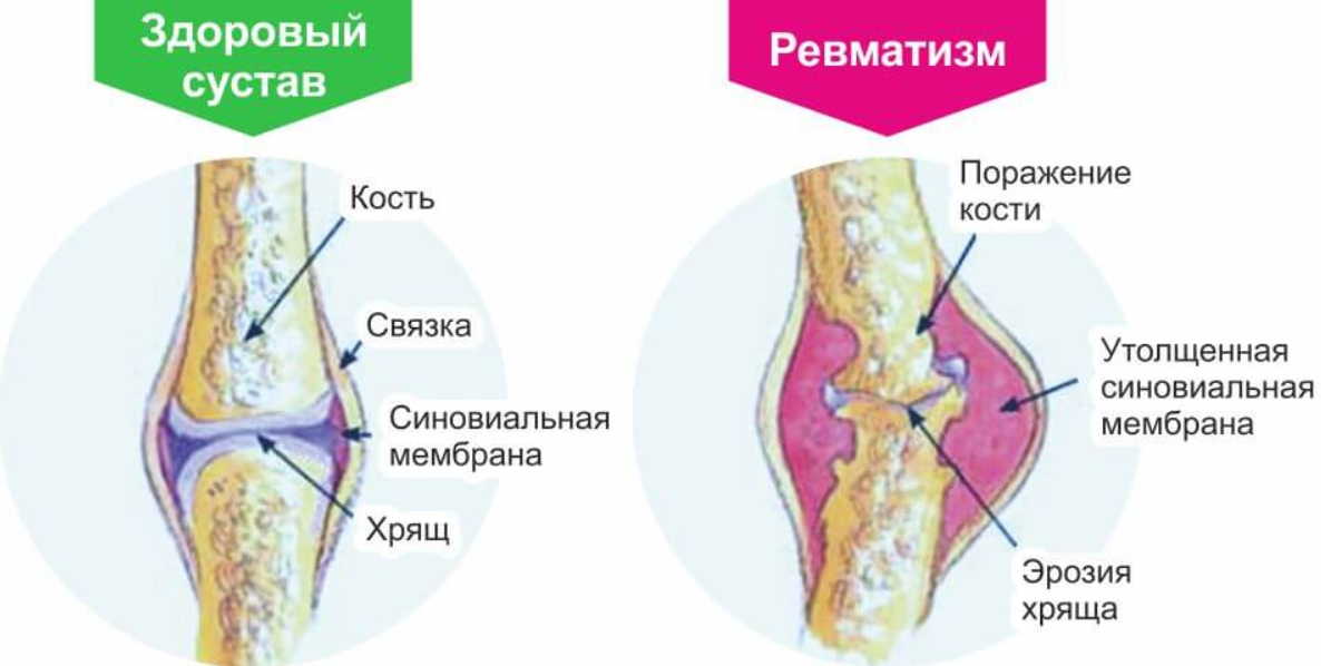 Лечение ревматизма народными методами: спасительные травы придут на помощь!