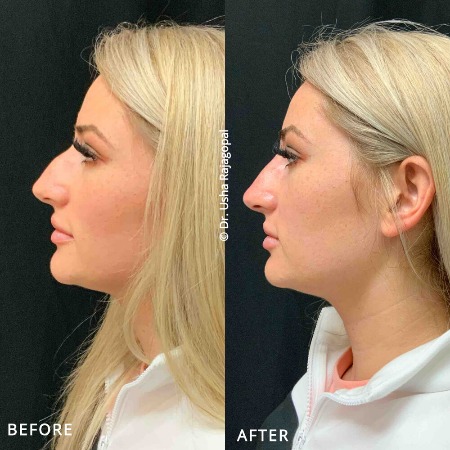 Безоперационная пластика носа: эксперты рассказывают о плюсах и минусах процедуры Экспертиза красоты