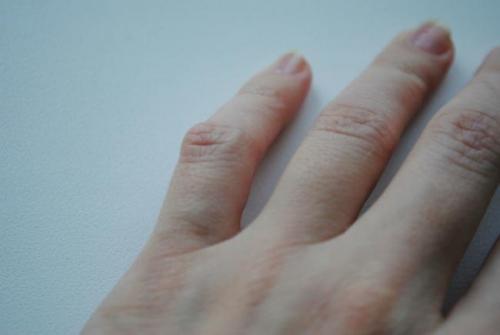 Шишка возле сустава пальца. Причины нарушения