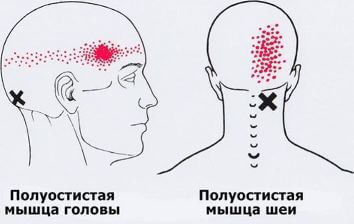 Карта точек боли в теле и точек напряжения мышц (триггеры)