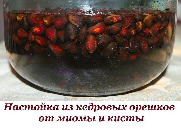 Как лечить кисту яичника без операции