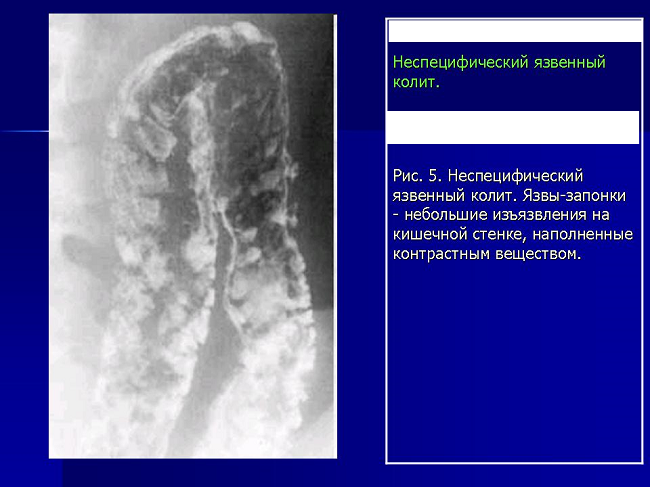 Неспецифический язвенный колит. Неспецифический язвенный колит макропрепарат. Неспецифический язвенный колит жалобы. Псевдомембранозный колит кт. Псевдомембранозный колит рентген.