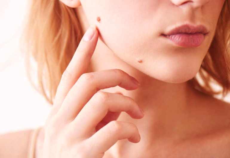 Меланома - самая опасная разновидность рака кожи. Можно ли удалять родинки? И как понять, что родинка безопасна?