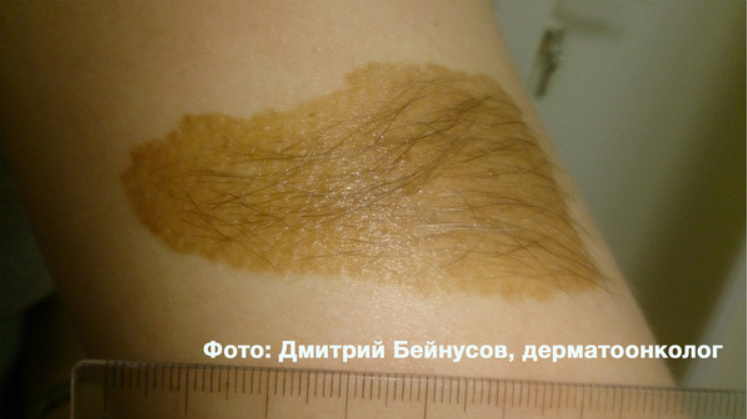 Меланома - самая опасная разновидность рака кожи. Можно ли удалять родинки? И как понять, что родинка безопасна?