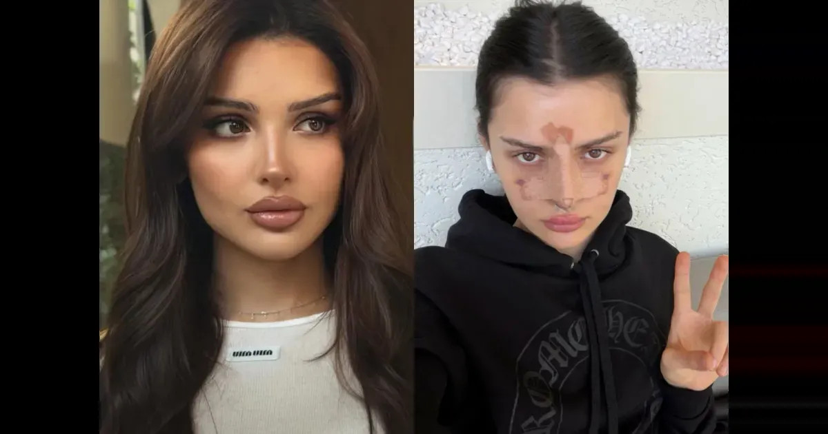 Дина Саева перенесла операцию на носу instagram (инстаграм),социальная сеть,Алессандра Амбросио,Виктория Боня,виктория лопырева,Дина Саева,Никита Ефремов,федеральная служба по финансовому мониторингу (росфинмониторинг)