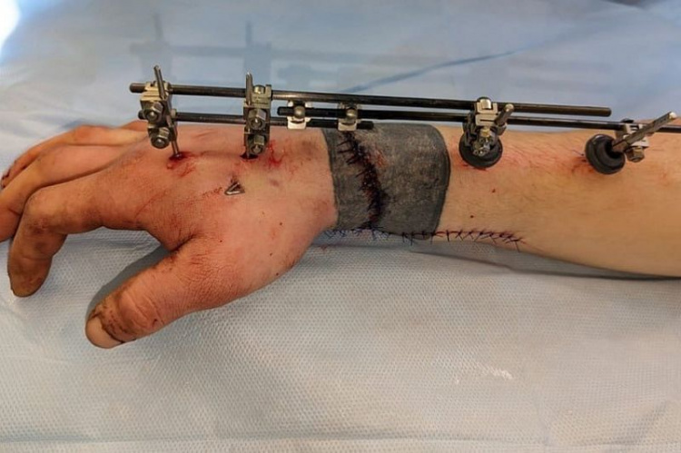 На Кубани парень отрубил себе кисть руки: краснодарские хирурги успешно пришили ее обратно